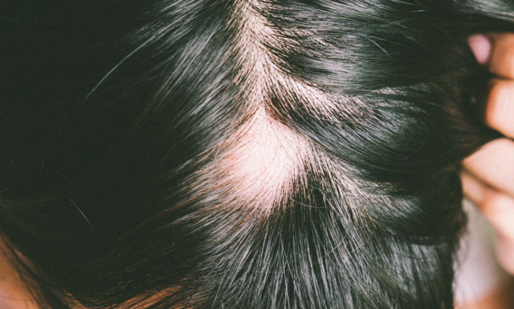 Hongo en el cuero cabelludo fenize